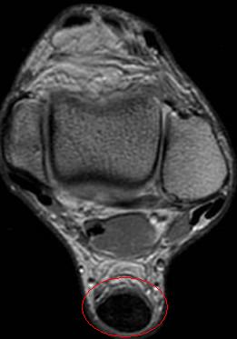 Thickening of the Achilles Tendon