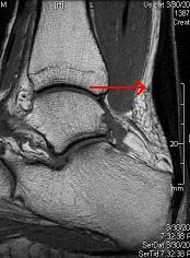 Tendon Round & Thick