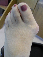 Bunion Surgery Seattle