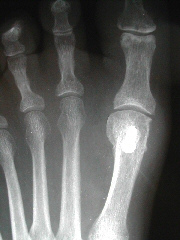 Bunion Foot Surgery Seattle