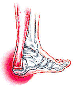Achilles Tendonitis Self Treatment