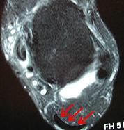 Normal Achilles Tendon