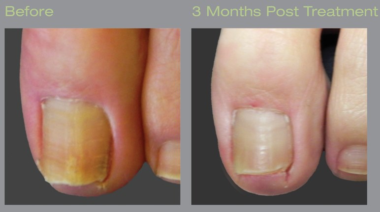 Laser Treatment For Toenail Fungus Onychomycosis