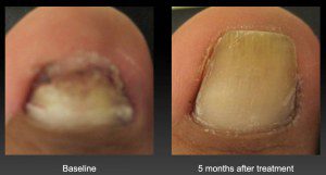 A Complete Guide to Toenail Fungus Treatment | Foot & Ankle