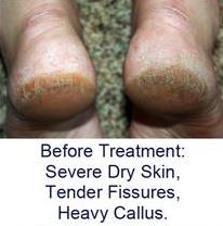 treating dry cracked feet