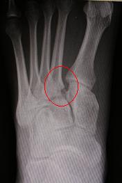 midfoot fracture