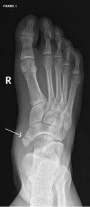 extra bone growth in foot