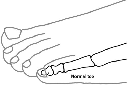 Hammertoe Treatment Guide | Seattle Specialists