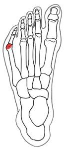 Tailor’s Bunion Surgery- A Complete Guide 