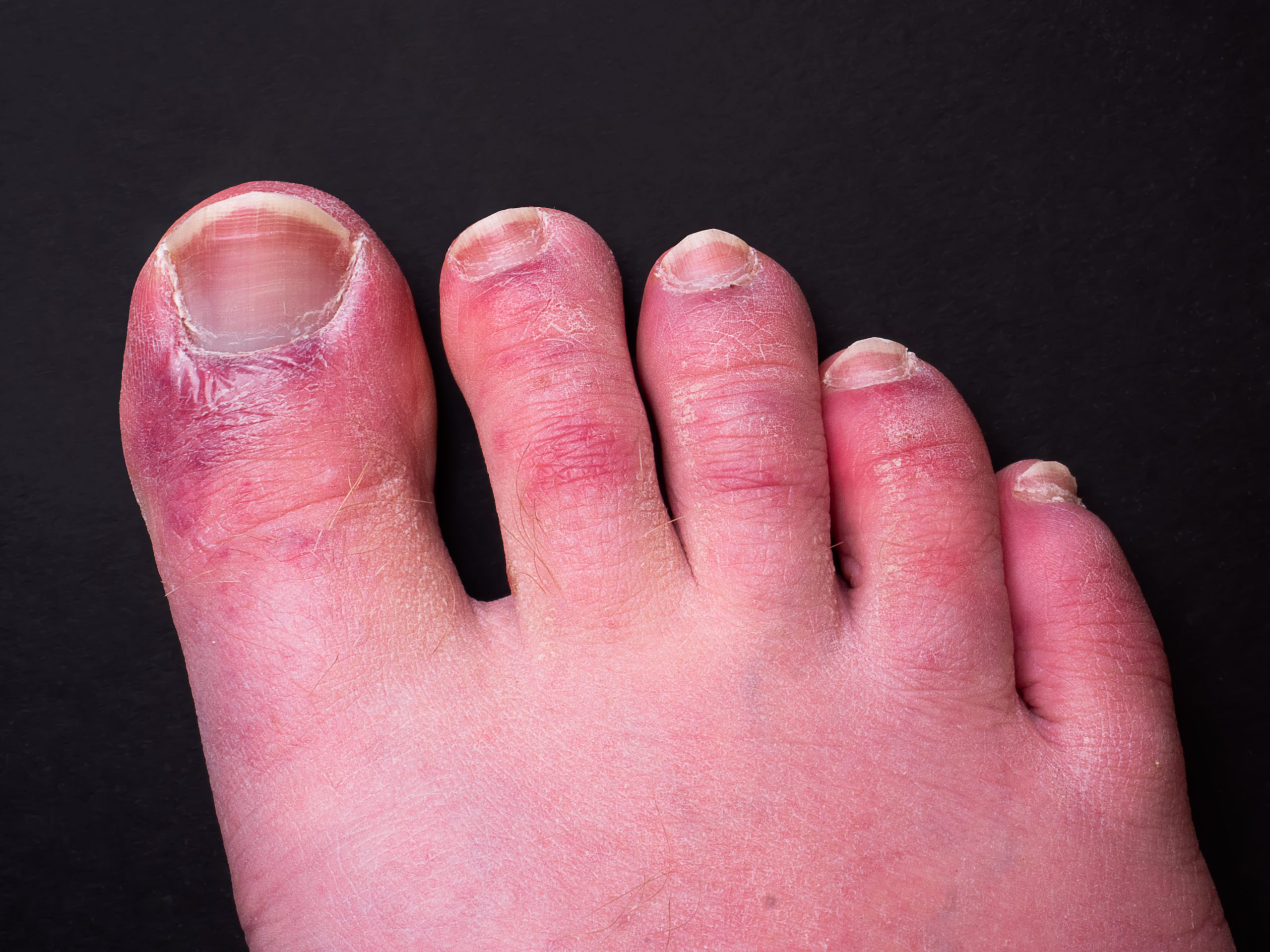 Painful Red Itching And Blistered Toes It Might Be Chilblains Foot
