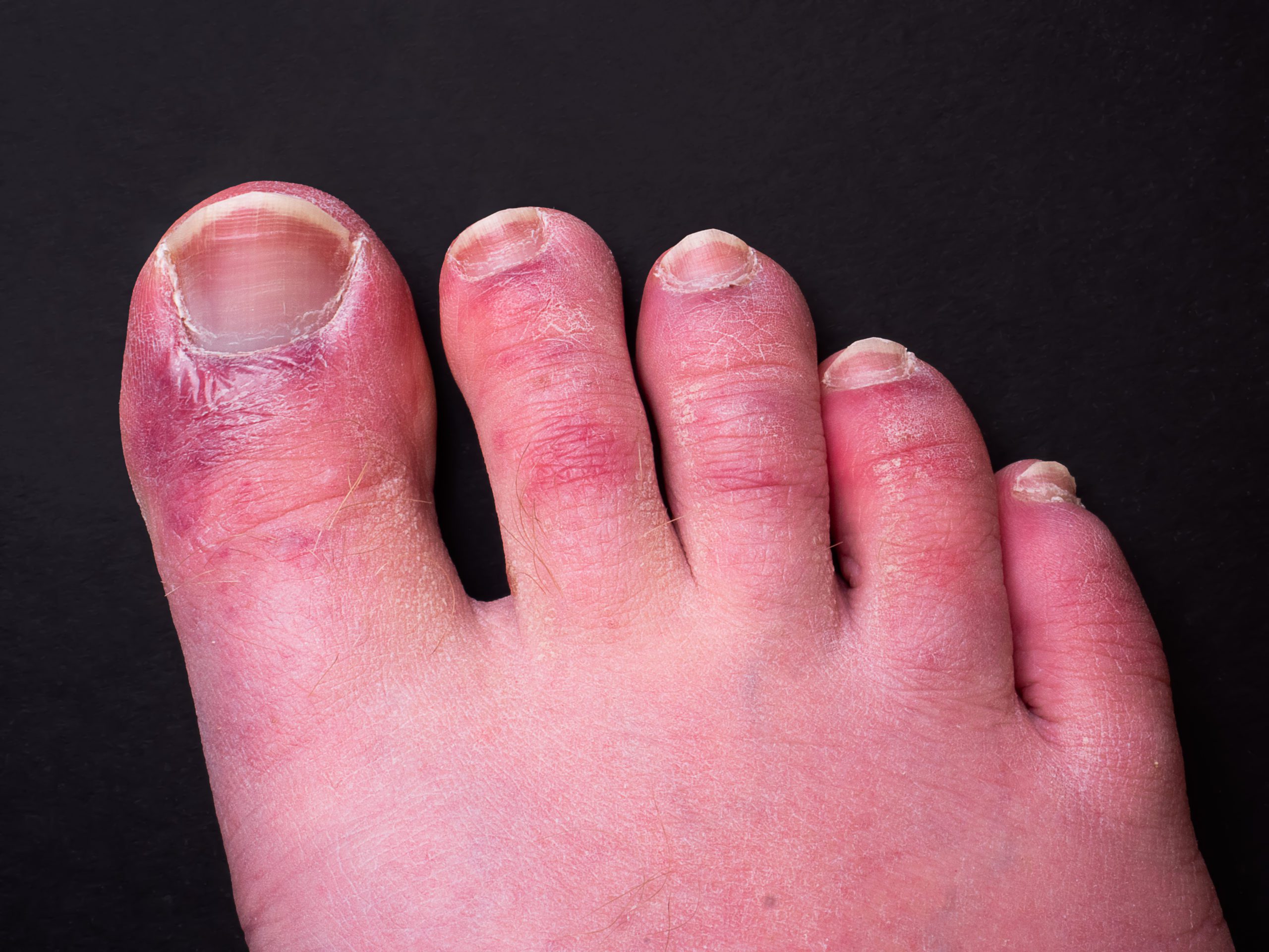 Painful Red Itching And Blistered Toes It Might Be Chilblains Foot 